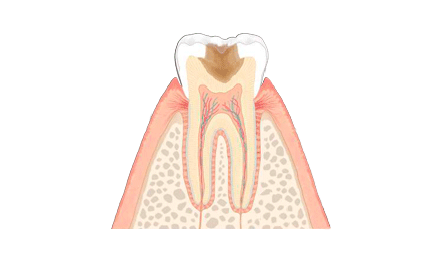 虫歯治療