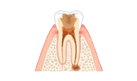 虫歯治療