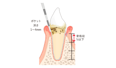 軽度歯周病