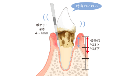 中度歯周病