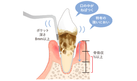 重度歯周病