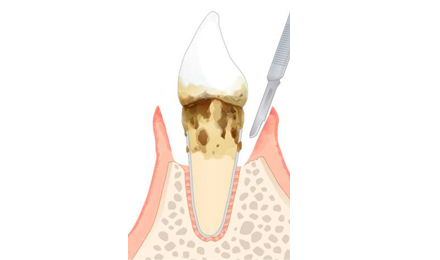 歯周外科治療(フラップ手術)